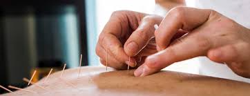 about-acupuncture about-acupuncture