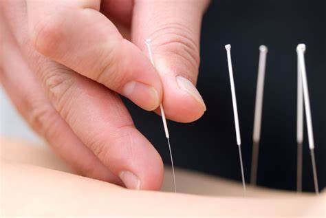 acupuncture-2