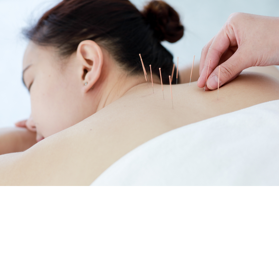 acupuncture-for-stress-3 acupuncture-for-stress-3