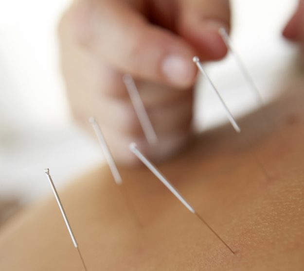 history-of-acupuncture-3